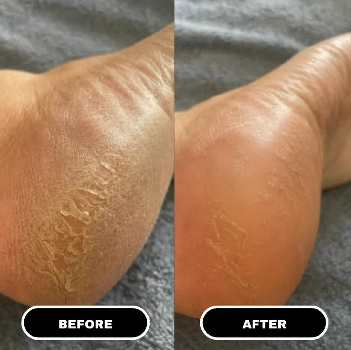 Nuvelle PureFoot Relief Stick™