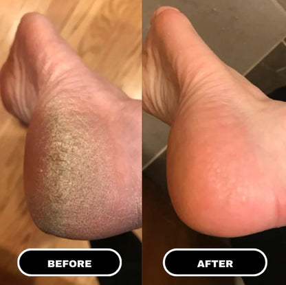 Nuvelle PureFoot Relief Stick™